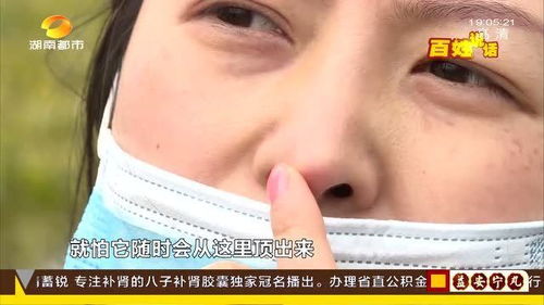 做完鼻修复 竟能直接摸到肋骨 女子 害怕填充物冲破鼻头