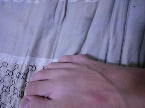 我穿篮球鞋,小脚趾下关节处张了个鼓包,摸着像骨头,穿硬一点的鞋又特别疼 怎么办