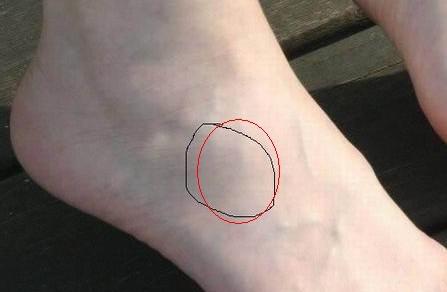 脚崴后骨头突起 解剖解析与科学处理指南