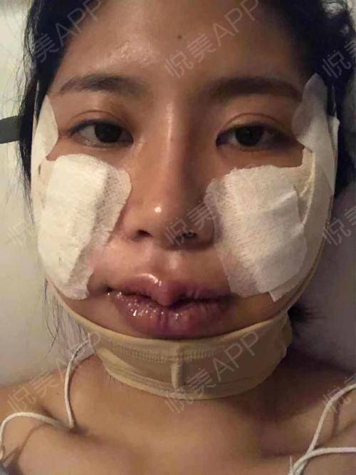 颧骨颧弓整形 专业诊断与个性化方案的重要性